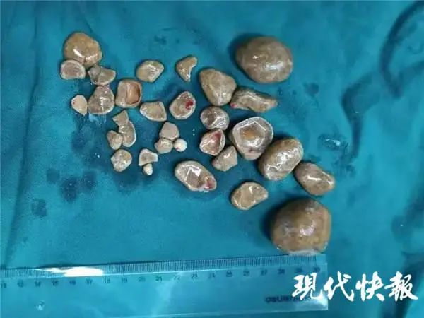 南通一男子膀胱里取出30枚结石!爱喝碳酸饮料