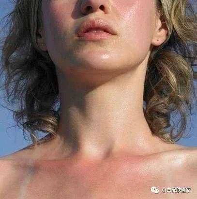 不小心晒伤怎么办 自救方法分享 看点快报