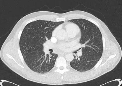 结节,肺部,ct,患者,治疗,急性粟粒型肺结核,结核,肺结核,尘肺病