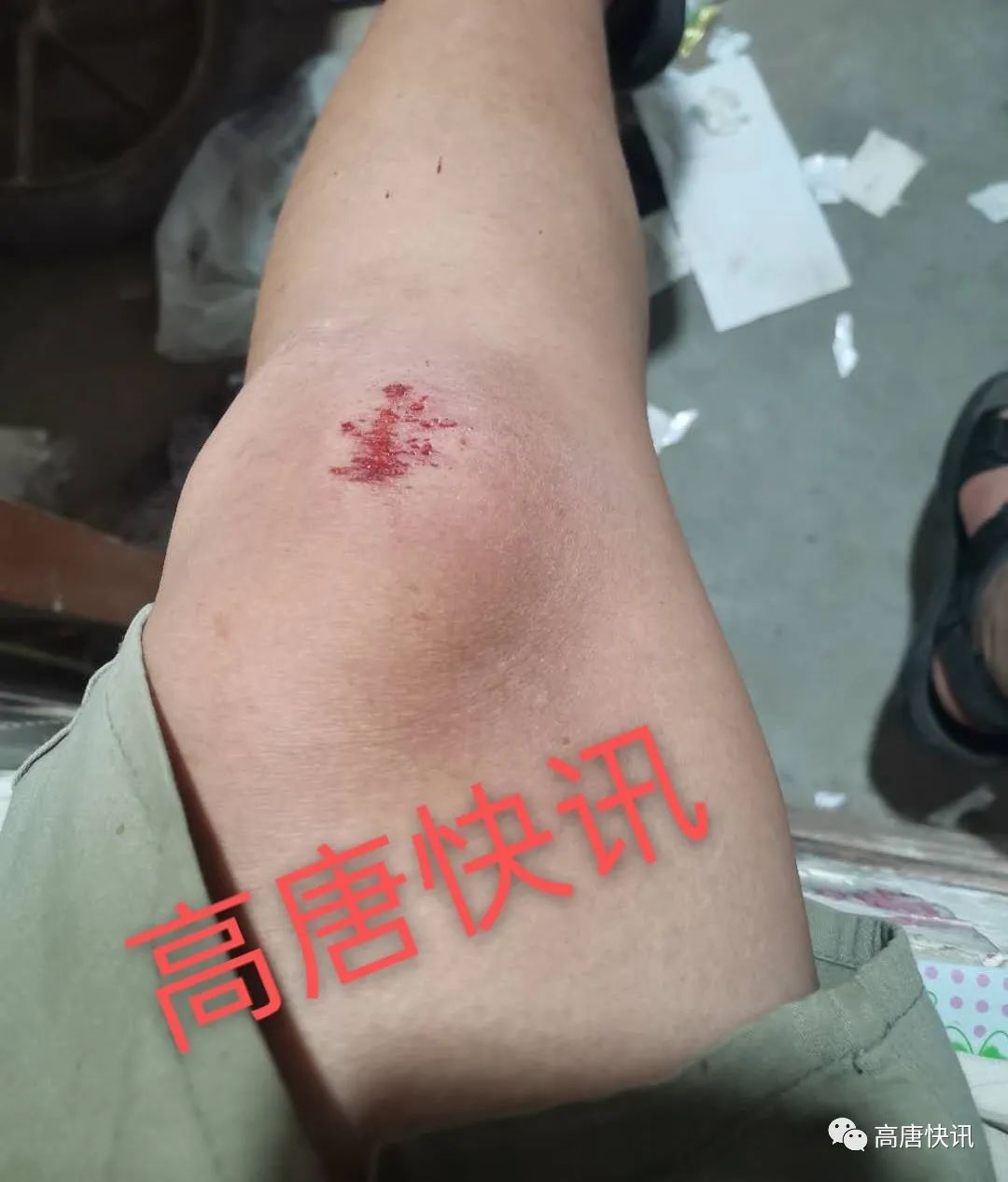 关注高唐马路留囗存隐患市民骑车磕掉牙