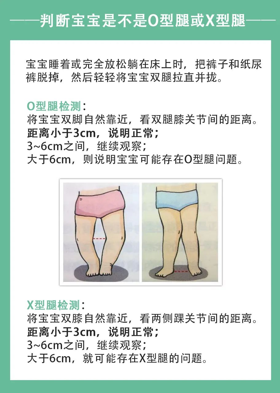 宝宝,o型腿,婴儿学步车