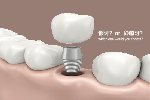 种植牙可以用医保吗 看点快报