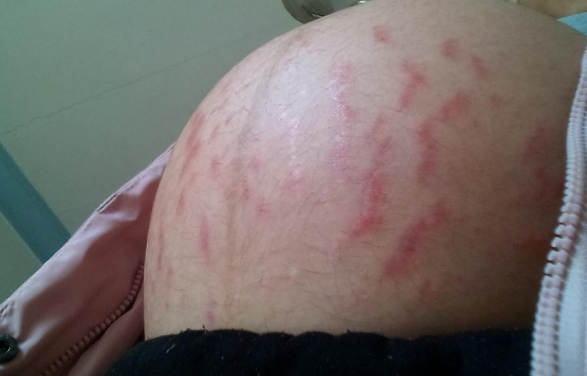 孕期妊娠纹