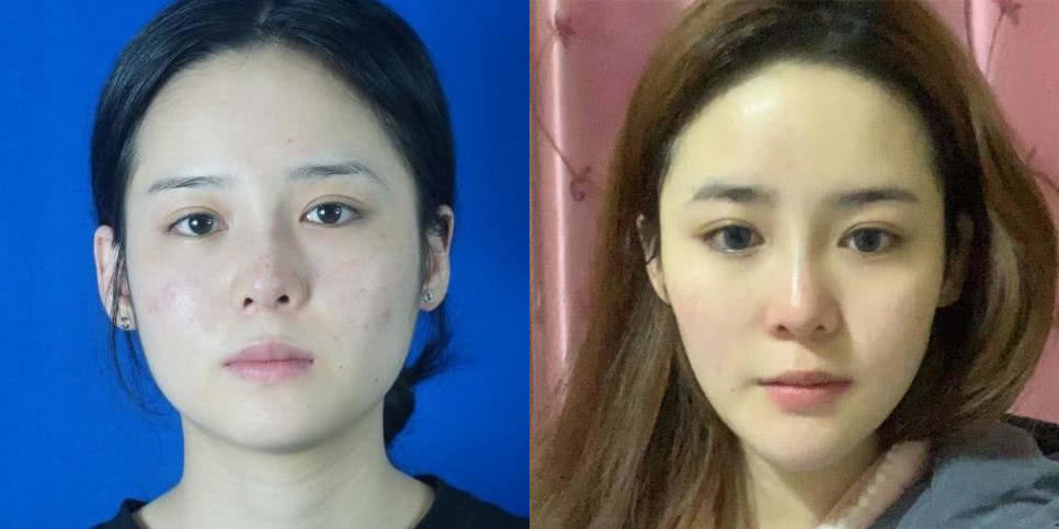 日本妹子花40w蜕变成天鹅 为什么有人整容后却效果不佳 看点快报