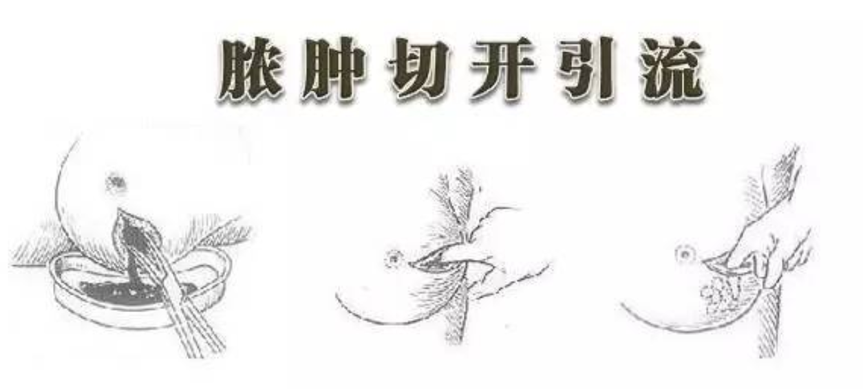 脓肿,乳痈,乳头,急性乳腺炎,哺乳,乳头皲裂,患者
