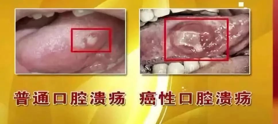 槟榔,口腔癌,口腔溃疡,水果,癌症