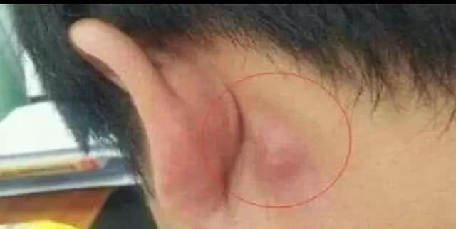 由耳后的乳突骨感染引起的炎症,会导致耳部肿胀和肿块的形成,还会