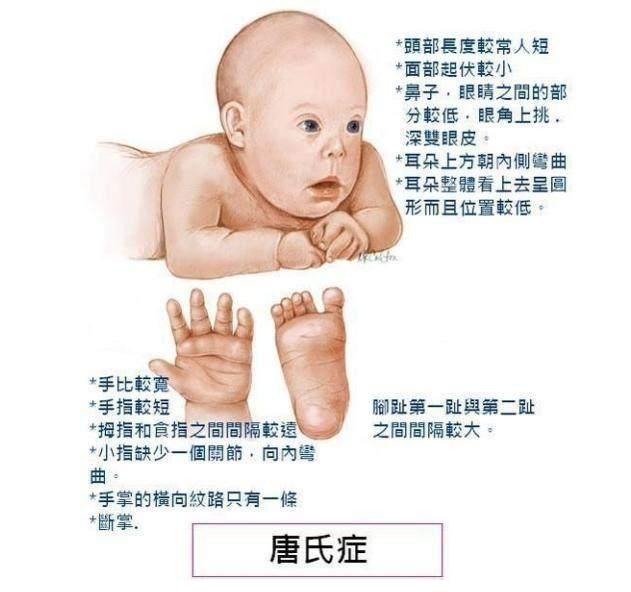 唐氏儿宝宝面部是什么样子?不想生个傻孩子,孕期这些检查不能省