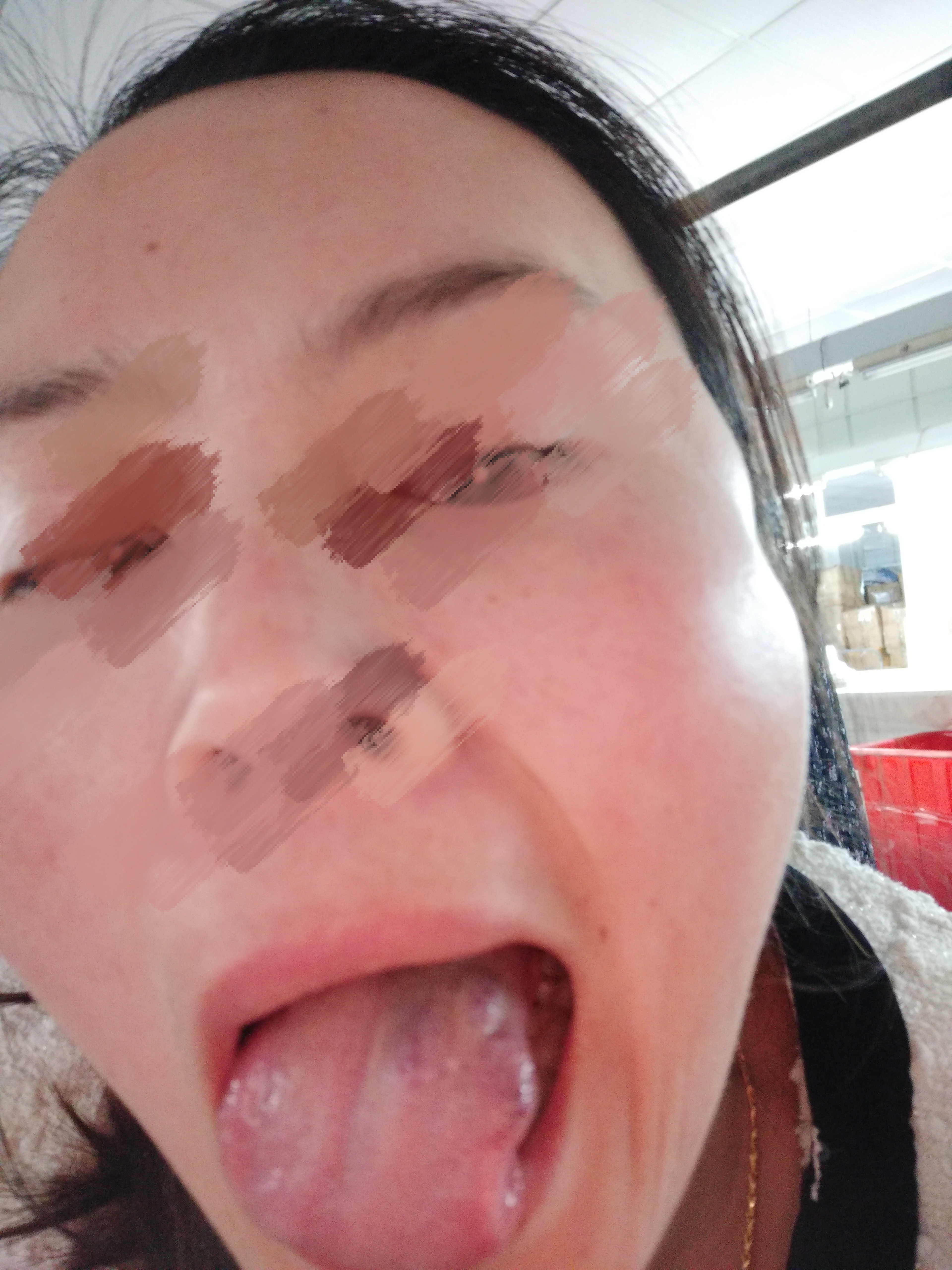 舌头,血管瘤,淋巴,淋巴管瘤,海绵状血管瘤,舌苔,肿瘤