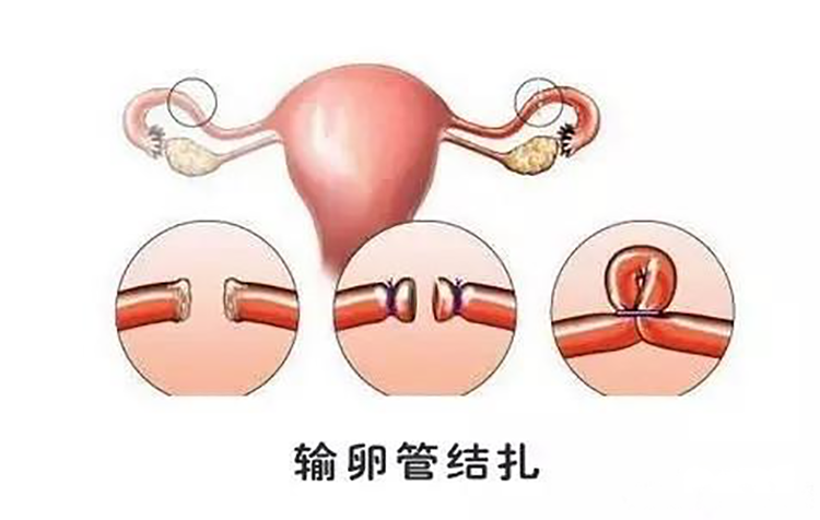 输卵管结扎好不好?