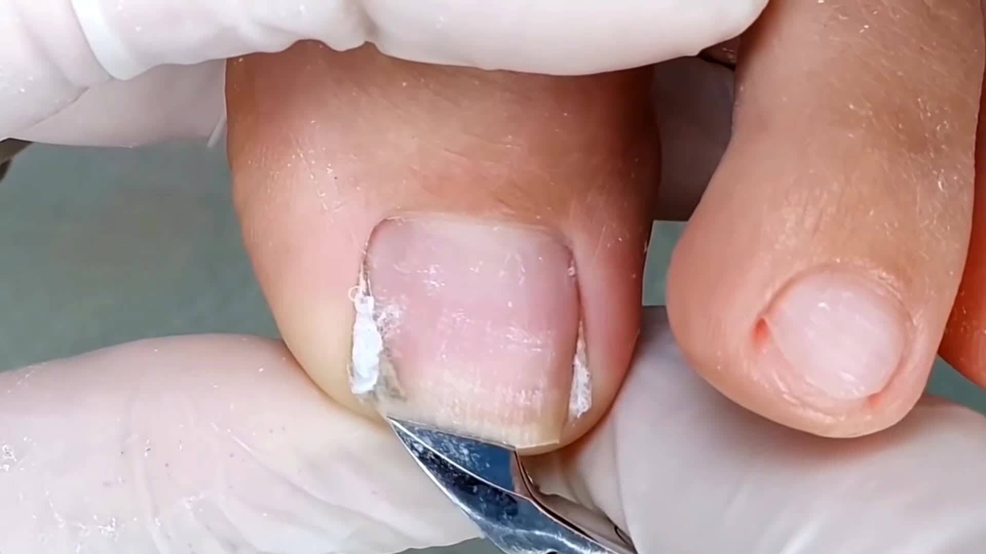 患有甲沟炎，自己可以在家治疗吗？