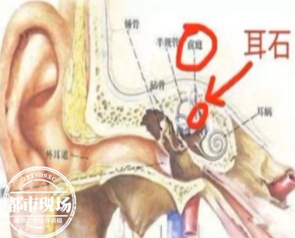 耳石被震脱落,现在路都走不稳了