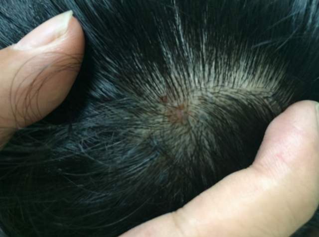 头皮,脓包,皮肤病,脂溢性皮炎,头发