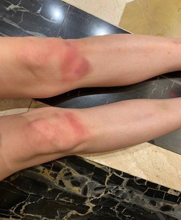 小s晒膝盖受伤照-看点快报