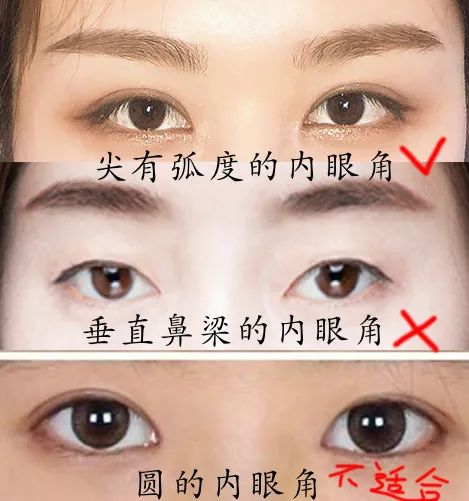 割双眼皮变丑系列(一),脸长的人适合做双眼皮吗