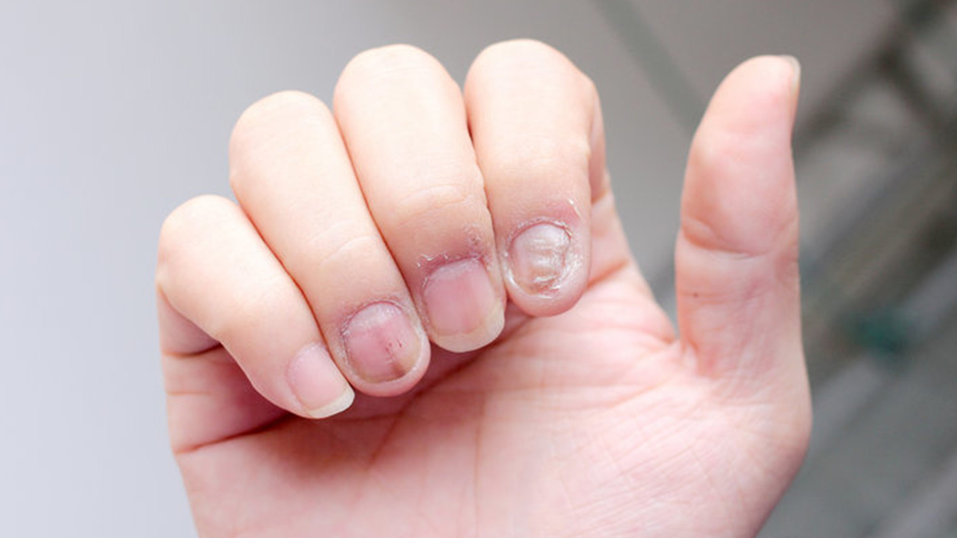 灰指甲如何预防？