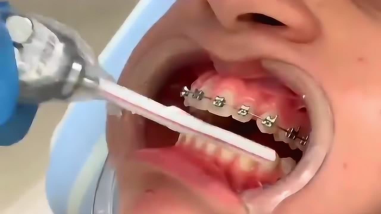 梦见牙齿掉一半，梦境背后的深层含义与心理解析