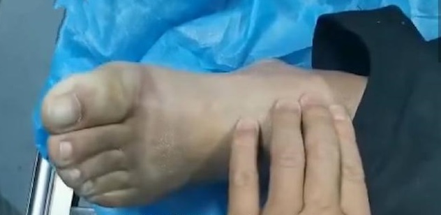 醉酒男子睡在小区门口,全身被冻僵面临截肢
