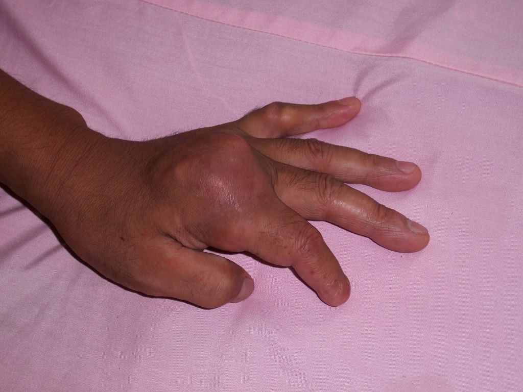 关节肿,痛,痛风怎么办?平时注意4点,消除炎症,缓解疼痛