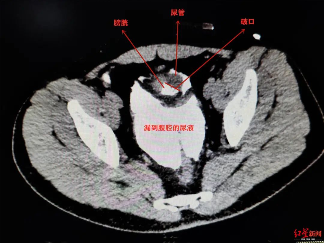 膀胱,尿液,排尿,憋尿,小李,腹腔,袁仁斌,前列腺