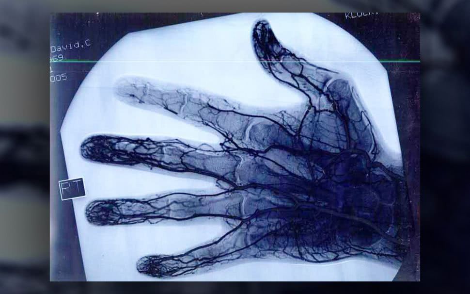 这是国外一个职业溜溜球手的右手x光片,看出有什么问题了吗?