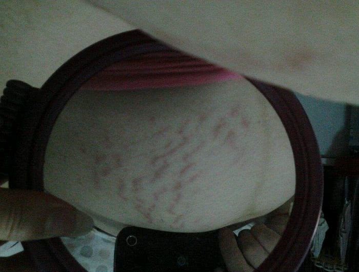 妊娠纹只可预防不可去除,产后做到这些,有效对抗妊娠纹