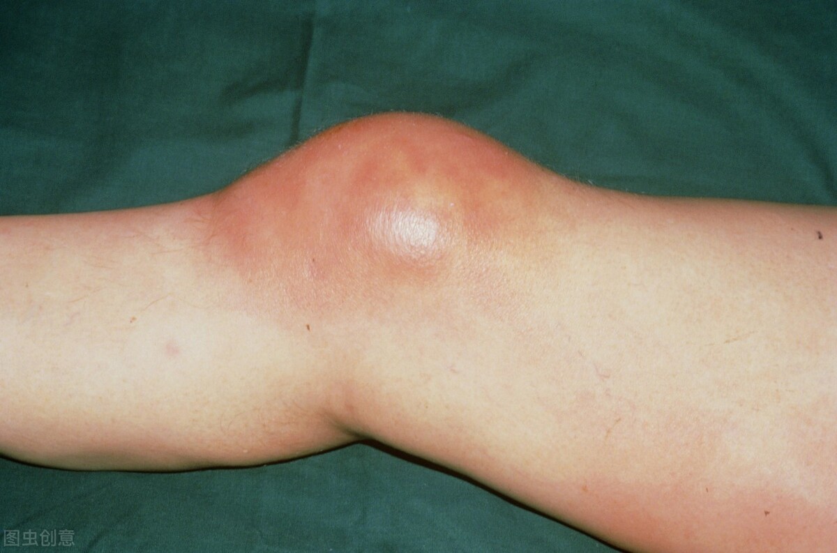 转告父母:3种错误运动方式,正在悄悄损伤我们的关节,尽早改正