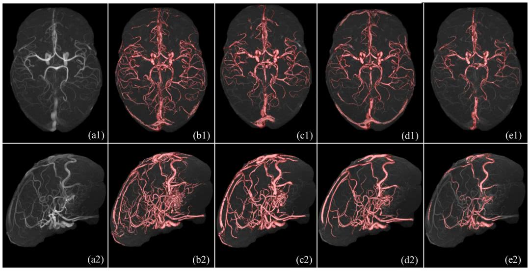 脑血管精准分割研究取得进展