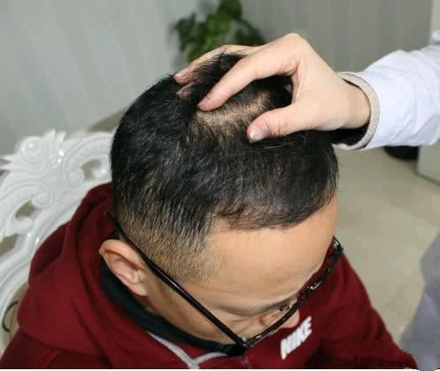 脱发,医生,王敏