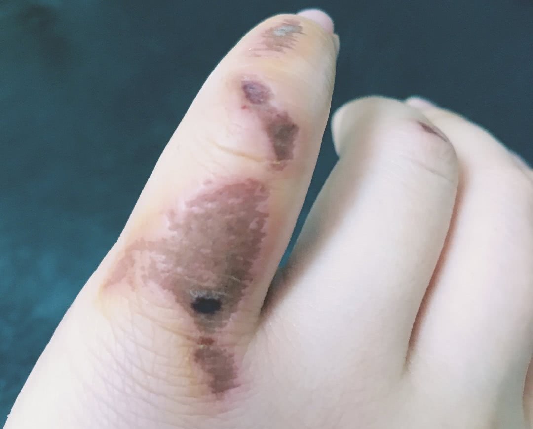 名门泽佳:冻疮有效小技巧,一学就会,冬天必备!