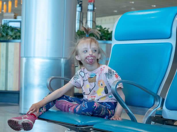 俄罗斯女孩天生只有半张脸遭歧视 父母被迫带她离开家乡