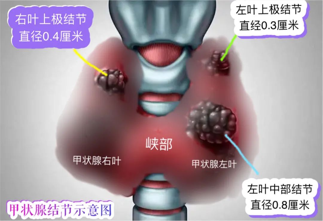 b超怀疑双侧甲状腺结节恶性,甲穿只提示一侧恶性,下一步怎么办?
