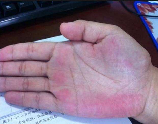 有光泽的,而糖尿病患者,若经常感到手掌小鱼际下端有明显发红的现象