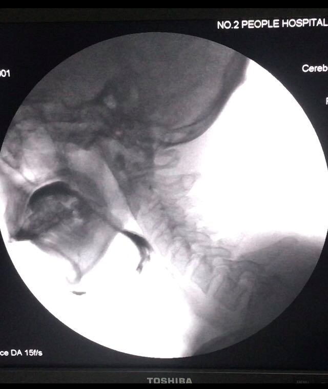 康复医学科成功开展吞咽造影术