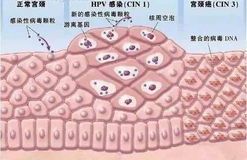 宫颈cin3级申请重疾险理赔,被保险公司拒赔,合理吗?