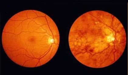 眼底出血,视网膜,黄斑,视网膜病变,患者,老年性黄斑变性,血管,症状