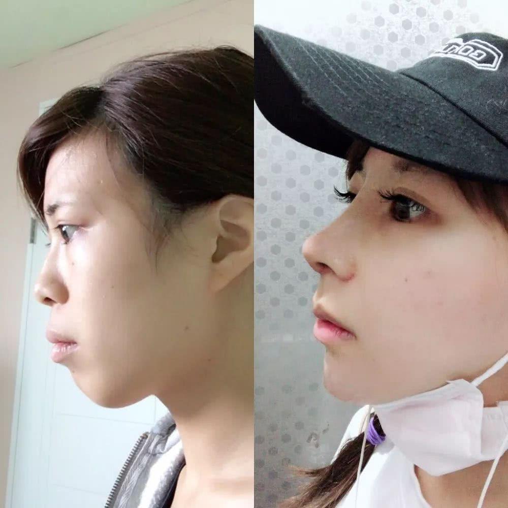 日女星花700万日元整容,模样惊艳如换头,自曝动刀经历堪比地狱