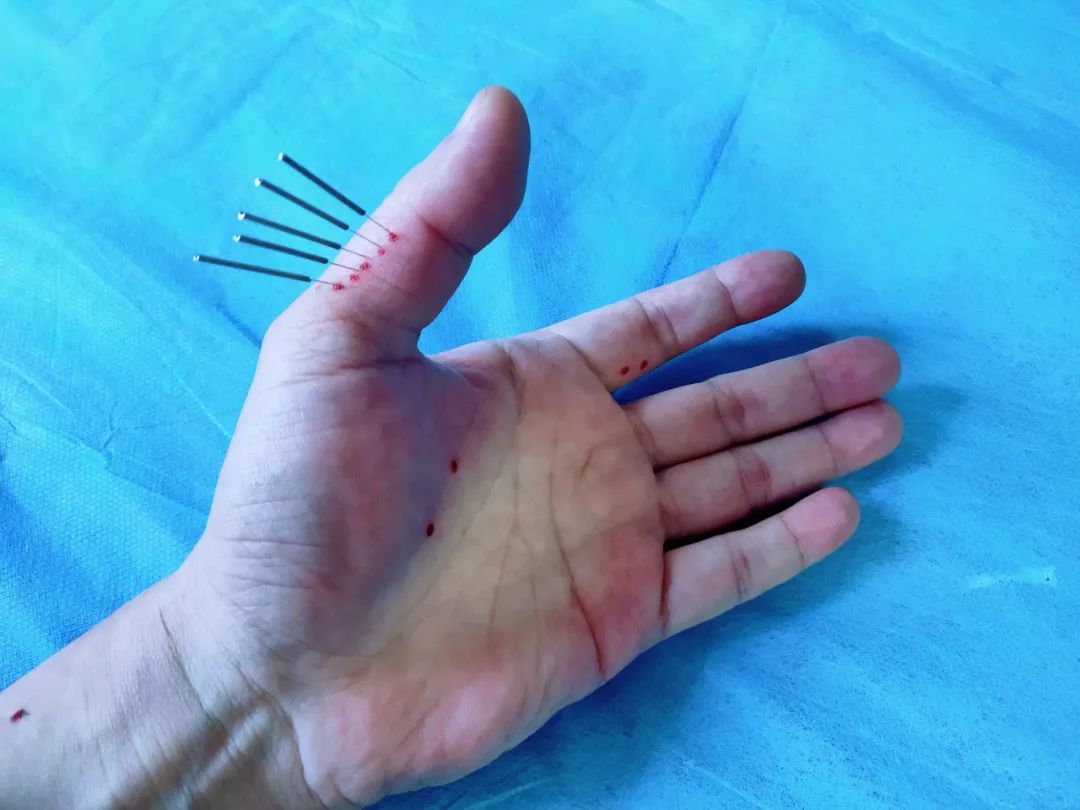 [转载]针刺如何得气？（入门技巧）