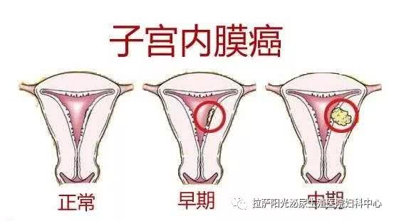白带,宫颈息肉,阴道出血,性生活,阴道炎,宫颈糜烂,宫颈癌