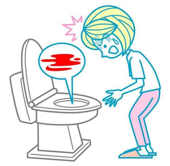 肛裂,肛门,静脉,痔疮,慢性肛裂