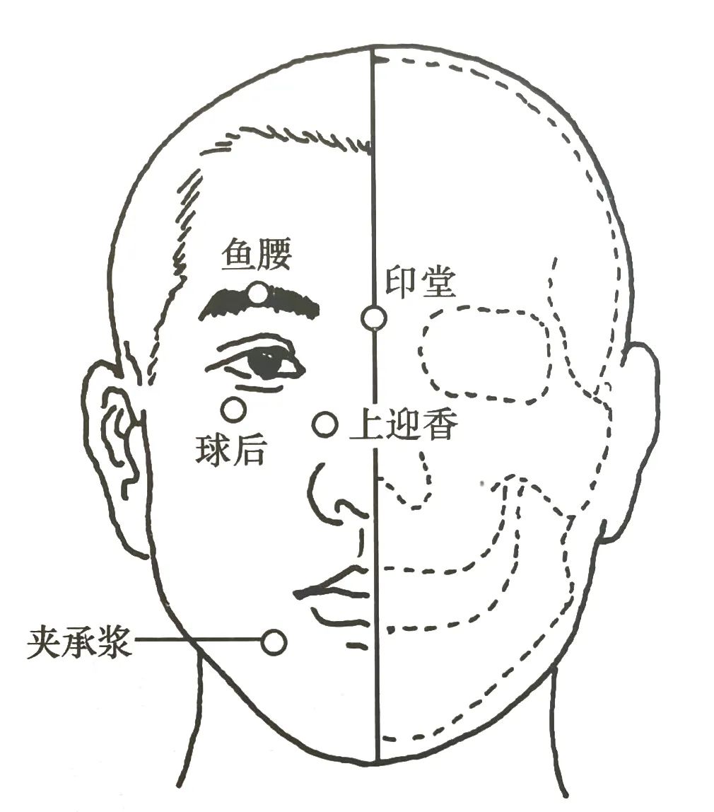 4种临床常见痛证的一针疗法
